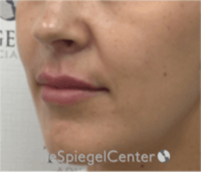 Lip Filler Before & After Gallery - Patient 157140803 - Image 4