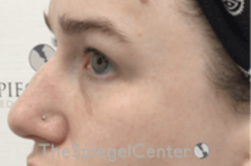 Non-Surgical Rhinoplasty / Nose Filler Before & After Gallery - Patient 157140806 - Image 3