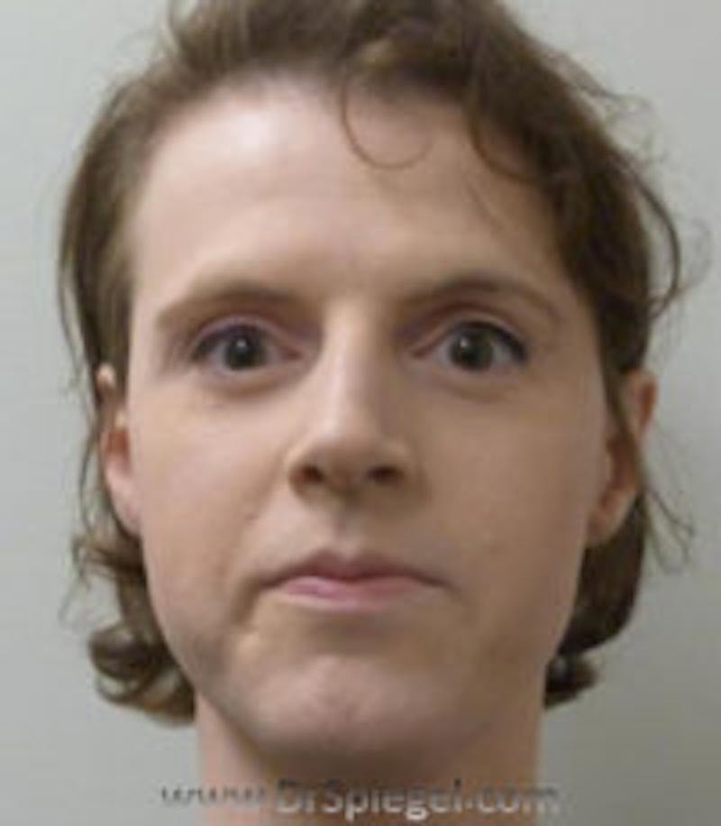 FFS Before & After Gallery - Patient 157140807 - Image 1
