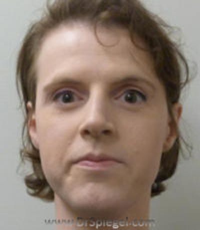 FFS Before & After Gallery - Patient 157140807 - Image 1