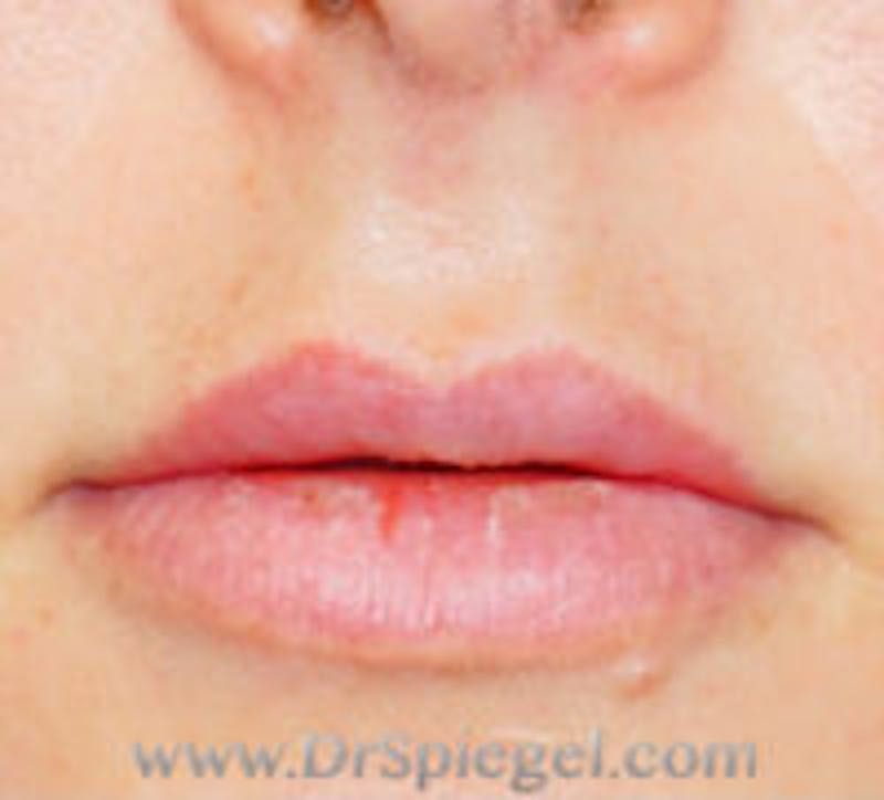 Lip Filler Before & After Gallery - Patient 157140808 - Image 1