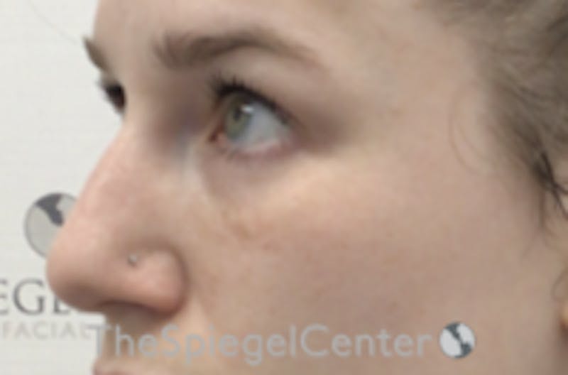 Non-Surgical Rhinoplasty / Nose Filler Before & After Gallery - Patient 157140806 - Image 4