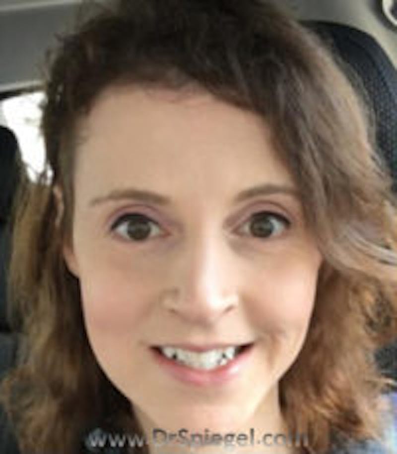 FFS Before & After Gallery - Patient 157140807 - Image 2