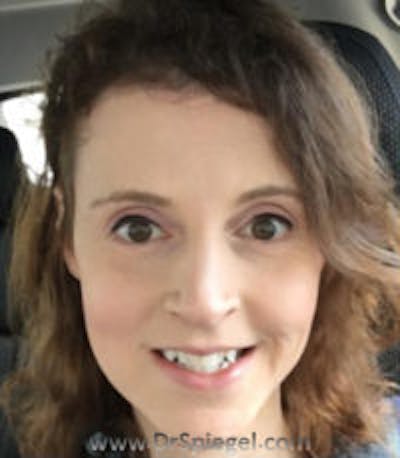 FFS Before & After Gallery - Patient 157140807 - Image 2