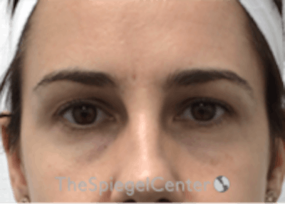 Tear Trough / Under Eye Fillers Before & After Gallery - Patient 157140809 - Image 1