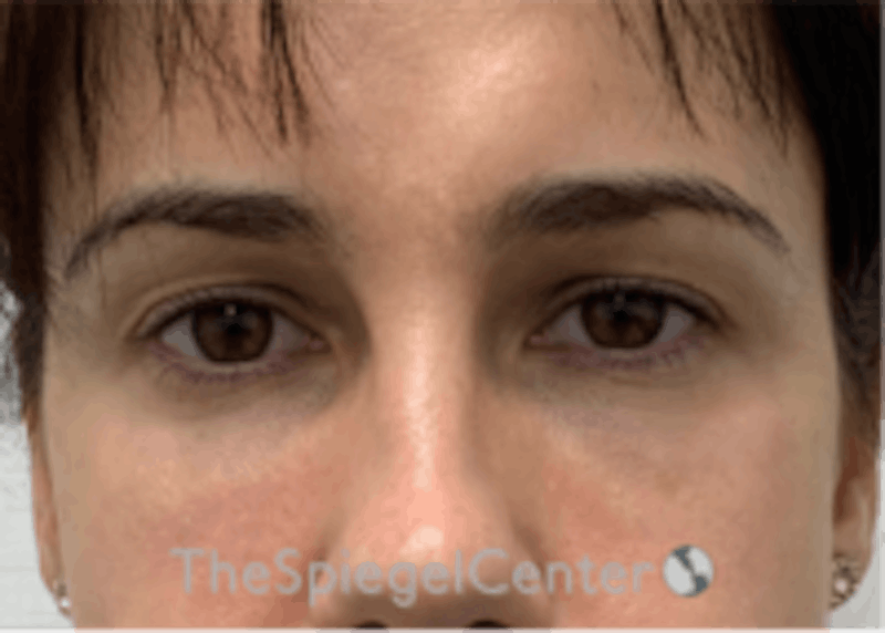 Tear Trough / Under Eye Fillers Before & After Gallery - Patient 157140809 - Image 2