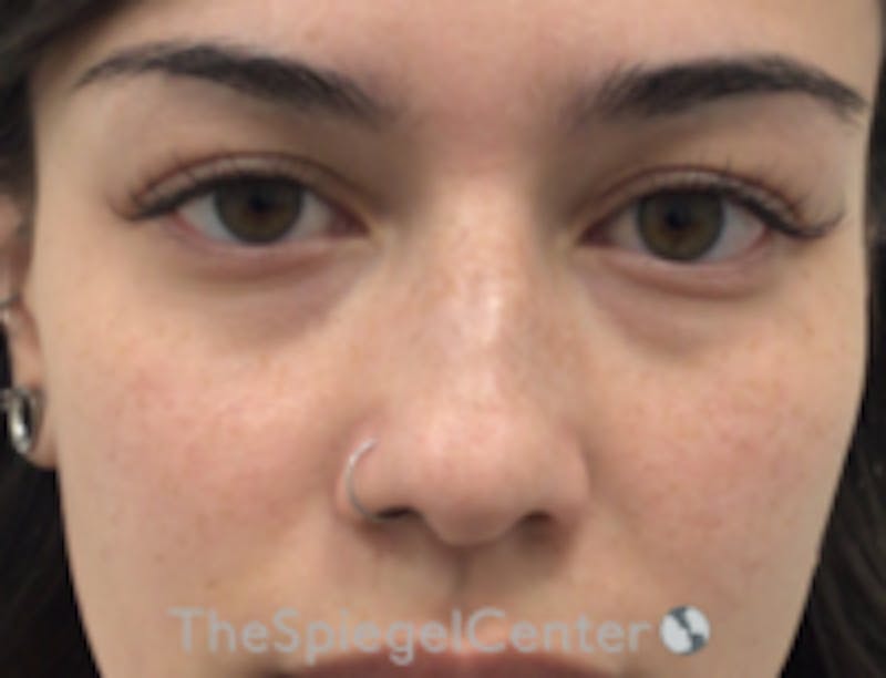 Non-Surgical Rhinoplasty / Nose Filler Before & After Gallery - Patient 157140811 - Image 1