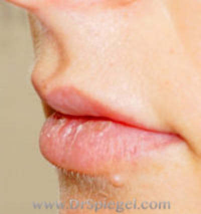Lip Filler Before & After Gallery - Patient 157140808 - Image 3