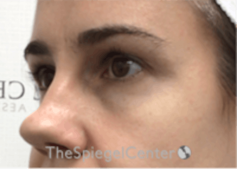 Tear Trough / Under Eye Fillers Before & After Gallery - Patient 157140809 - Image 3