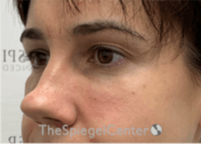 Tear Trough / Under Eye Fillers Before & After Gallery - Patient 157140809 - Image 4