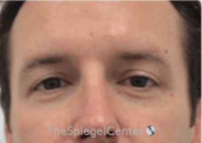 Tear Trough / Under Eye Fillers Before & After Gallery - Patient 157140814 - Image 1