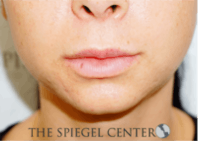 Lip Filler Before & After Gallery - Patient 157140813 - Image 1