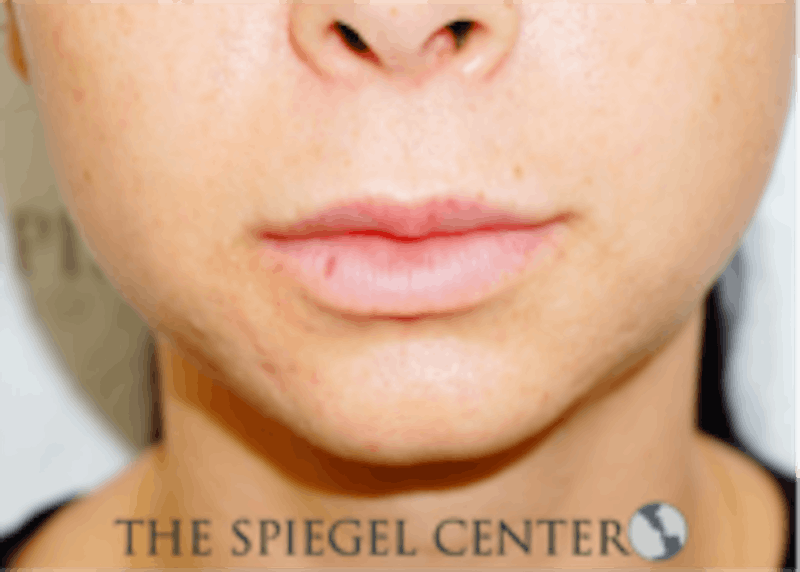 Lip Filler Before & After Gallery - Patient 157140813 - Image 1