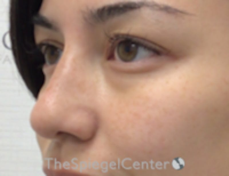 Non-Surgical Rhinoplasty / Nose Filler Before & After Gallery - Patient 157140811 - Image 4