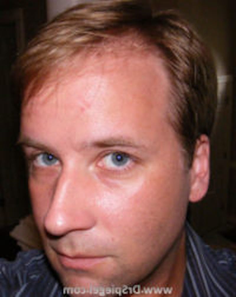 FFS Before & After Gallery - Patient 157140812 - Image 1