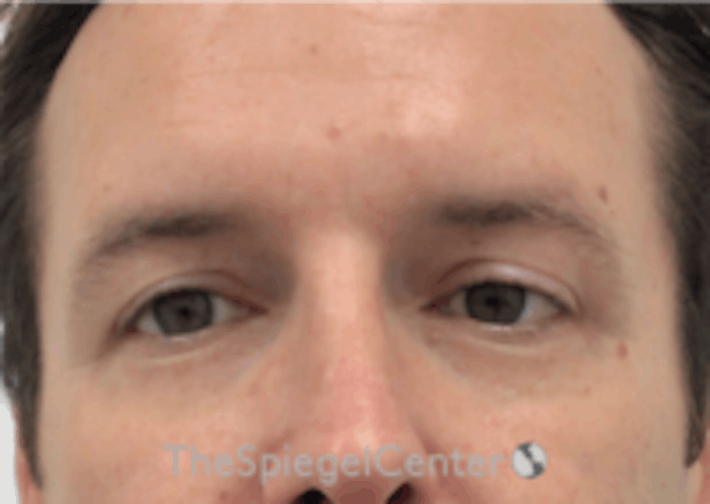 Tear Trough / Under Eye Fillers Before & After Gallery - Patient 157140814 - Image 2