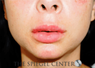 Lip Filler Before & After Gallery - Patient 157140813 - Image 2