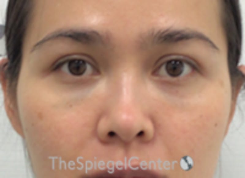 Non-Surgical Rhinoplasty / Nose Filler Before & After Gallery - Patient 157140815 - Image 1