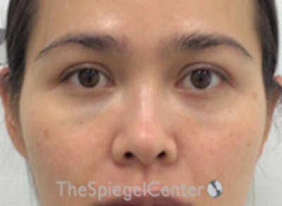 Non-Surgical Rhinoplasty / Nose Filler Before & After Gallery - Patient 157140815 - Image 1