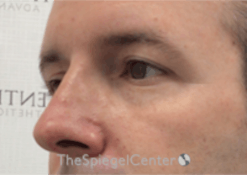 Tear Trough / Under Eye Fillers Before & After Gallery - Patient 157140814 - Image 3