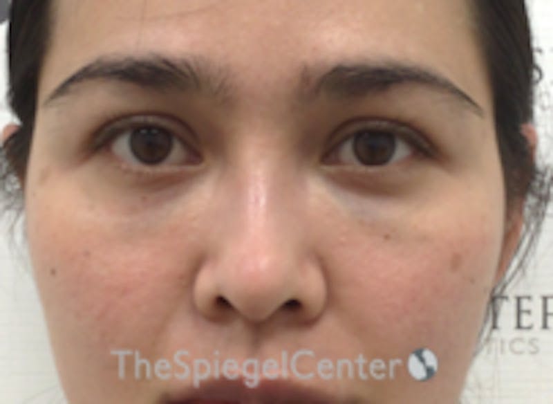 Non-Surgical Rhinoplasty / Nose Filler Before & After Gallery - Patient 157140815 - Image 2