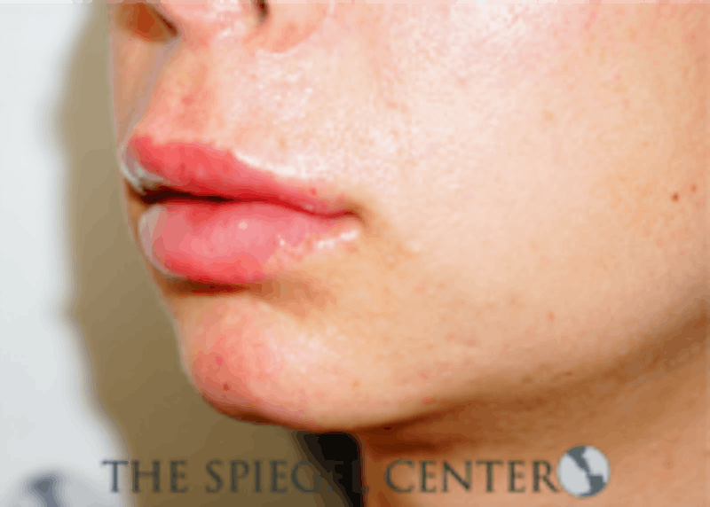 Lip Filler Before & After Gallery - Patient 157140813 - Image 4