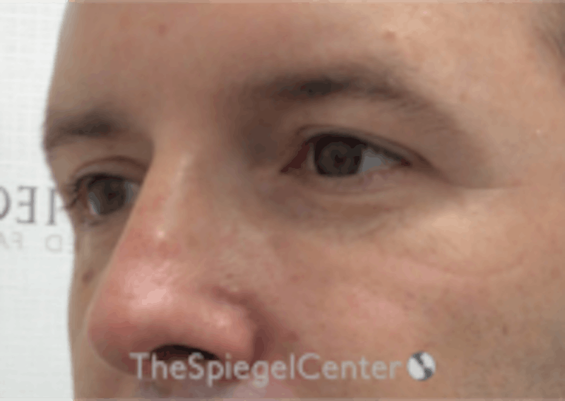 Tear Trough / Under Eye Fillers Before & After Gallery - Patient 157140814 - Image 4