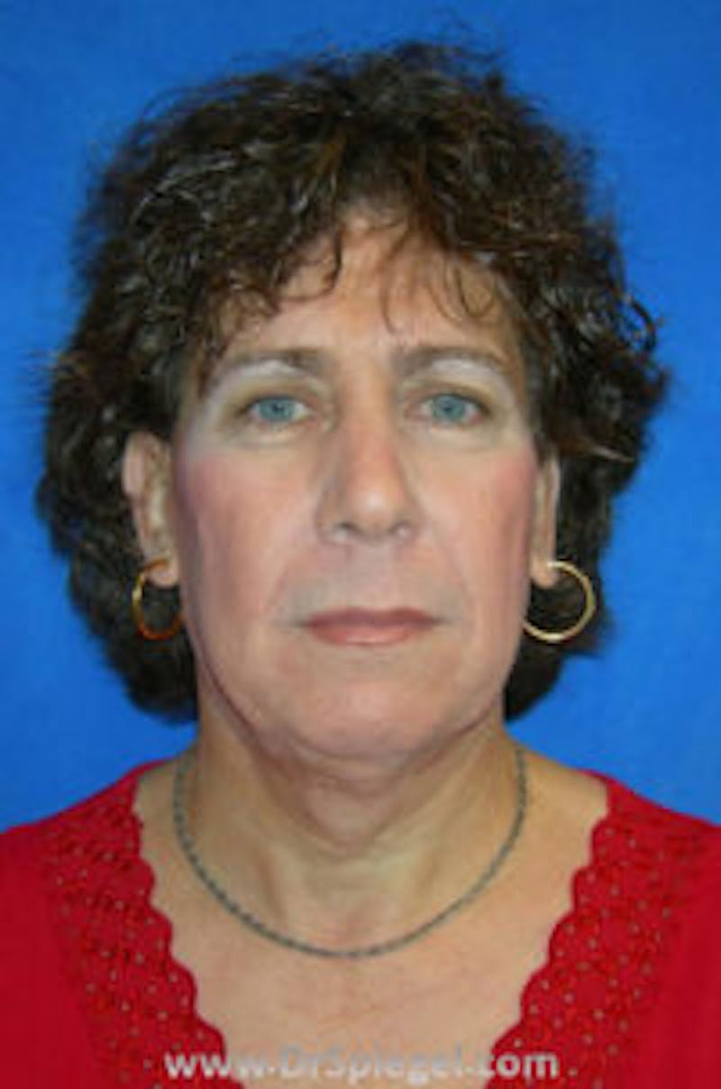 FFS Before & After Gallery - Patient 157140816 - Image 1