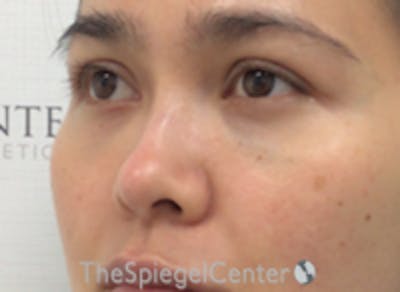 Non-Surgical Rhinoplasty / Nose Filler Before & After Gallery - Patient 157140815 - Image 3