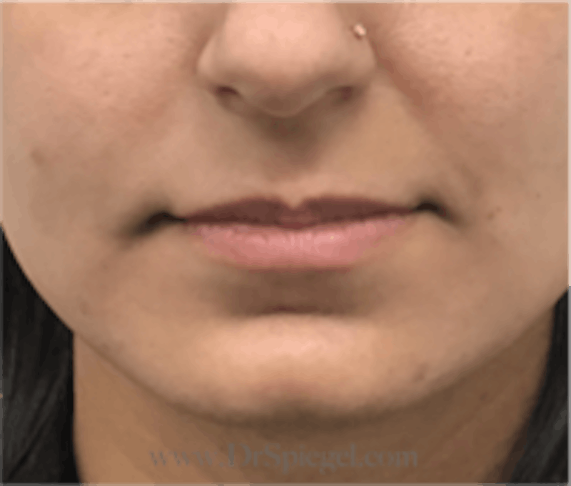 Lip Filler Before & After Gallery - Patient 157140818 - Image 1