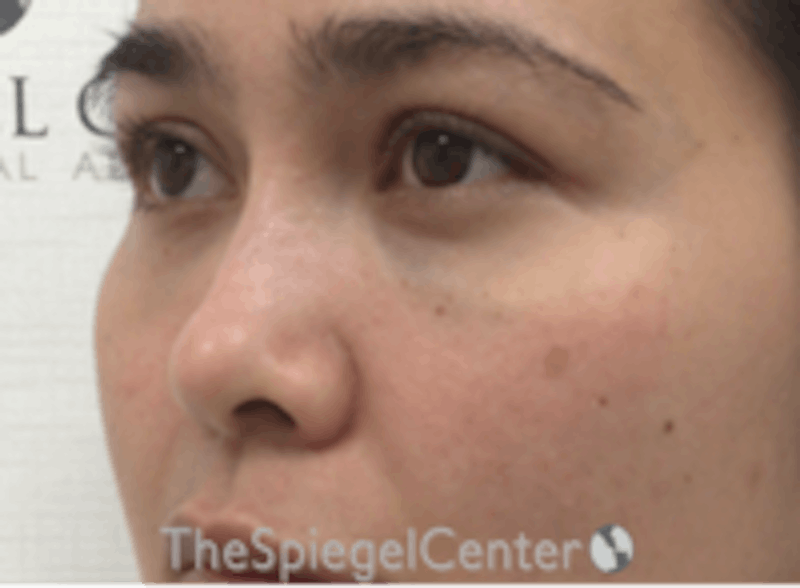 Non-Surgical Rhinoplasty / Nose Filler Before & After Gallery - Patient 157140815 - Image 4