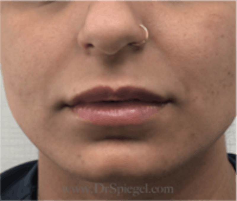 Lip Filler Before & After Gallery - Patient 157140818 - Image 2