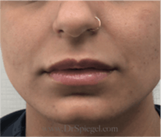 Lip Filler Before & After Gallery - Patient 157140818 - Image 2