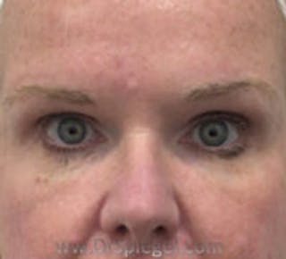 Tear Trough / Under Eye Fillers Before & After Gallery - Patient 157140817 - Image 2