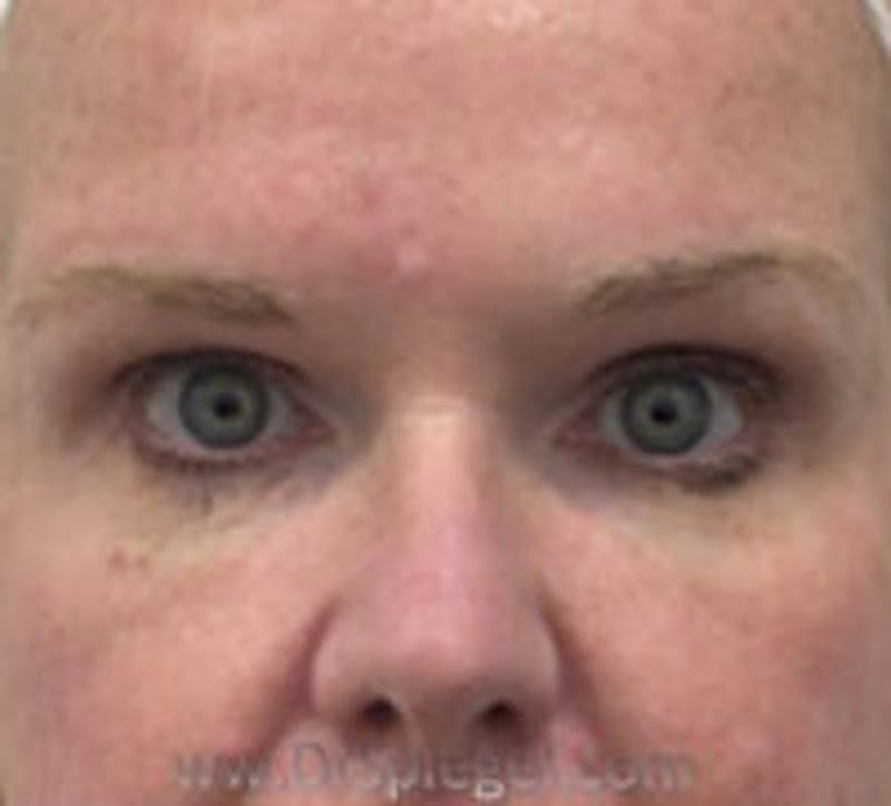 Tear Trough / Under Eye Fillers Before & After Gallery - Patient 157140817 - Image 2