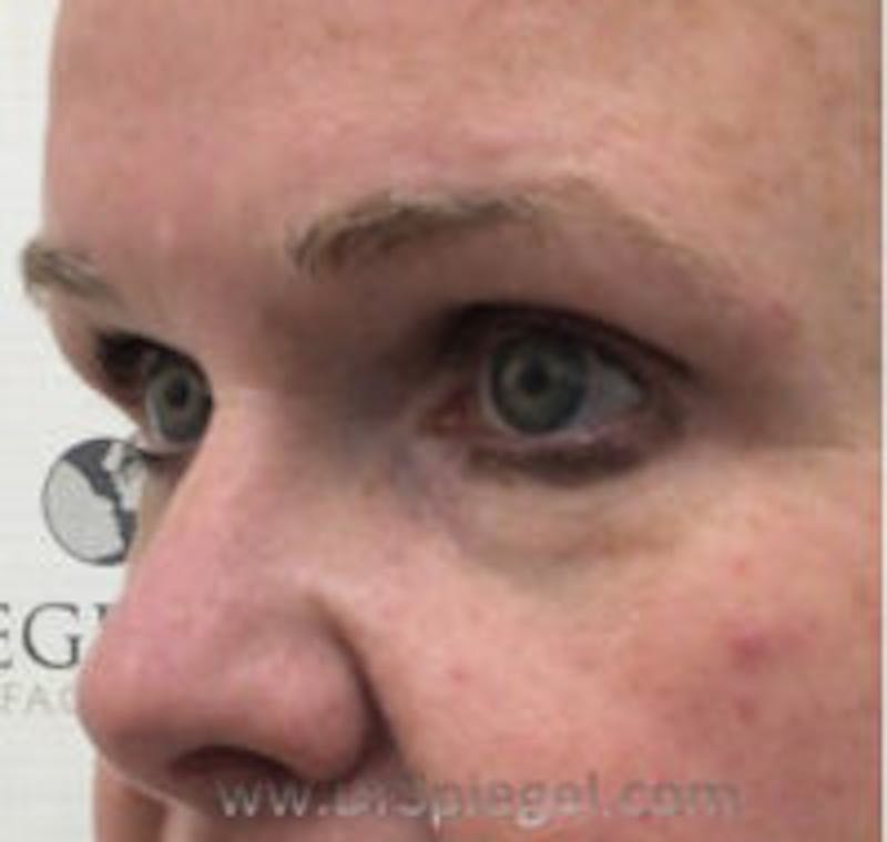 Tear Trough / Under Eye Fillers Before & After Gallery - Patient 157140817 - Image 3