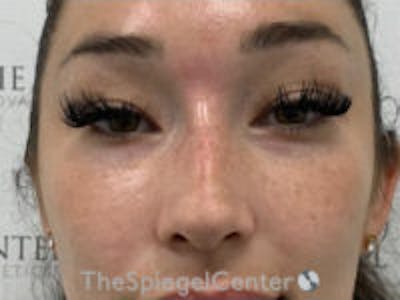 Non-Surgical Rhinoplasty / Nose Filler Before & After Gallery - Patient 157140820 - Image 1