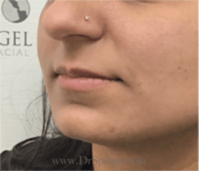 Lip Filler Before & After Gallery - Patient 157140818 - Image 3