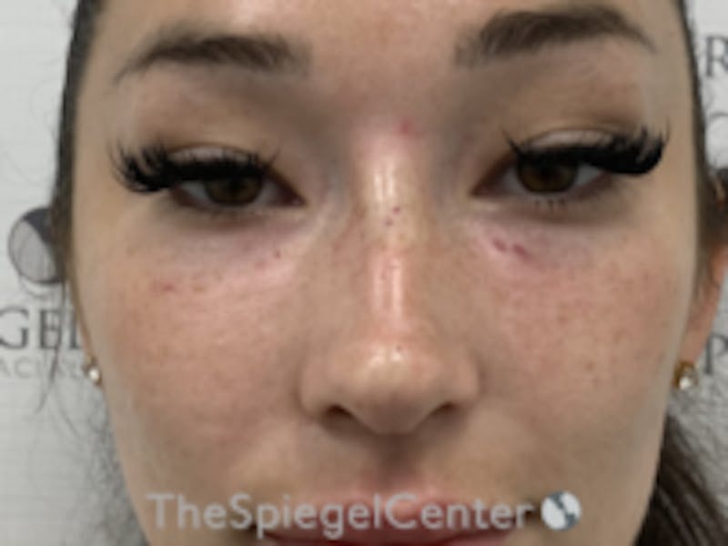 Non-Surgical Rhinoplasty / Nose Filler Before & After Gallery - Patient 157140820 - Image 2