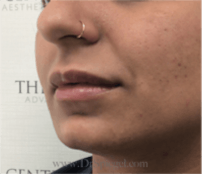 Lip Filler Before & After Gallery - Patient 157140818 - Image 4