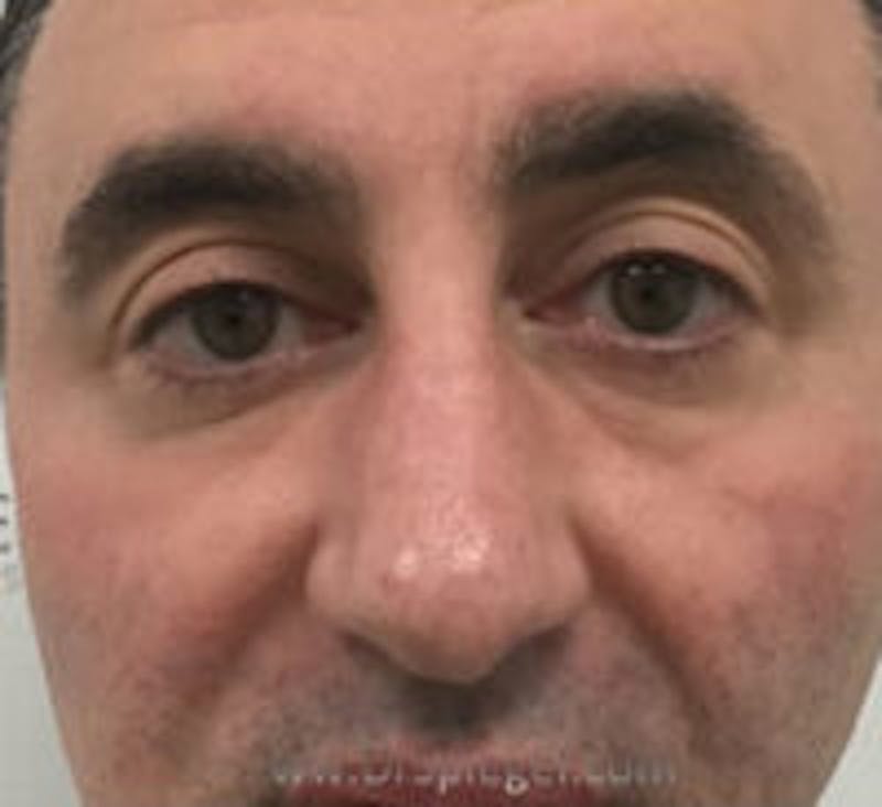 Tear Trough / Under Eye Fillers Before & After Gallery - Patient 157140821 - Image 1