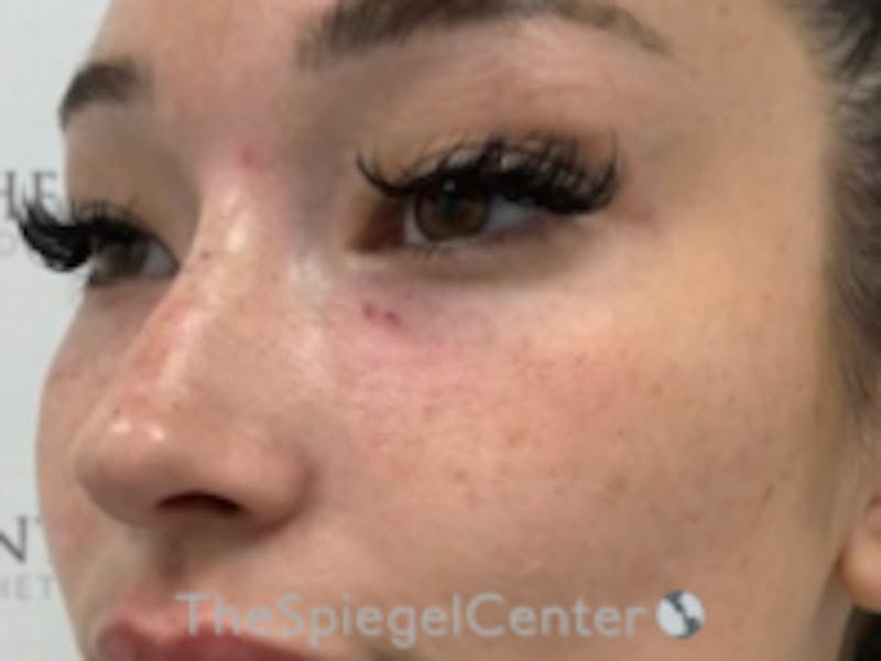 Non-Surgical Rhinoplasty / Nose Filler Before & After Gallery - Patient 157140820 - Image 4