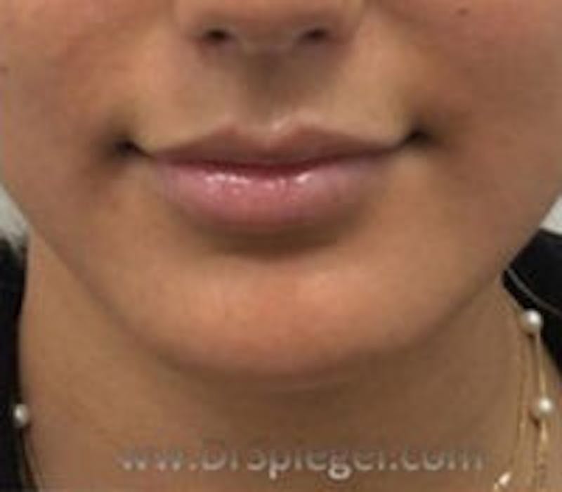 Lip Filler Before & After Gallery - Patient 157140823 - Image 1