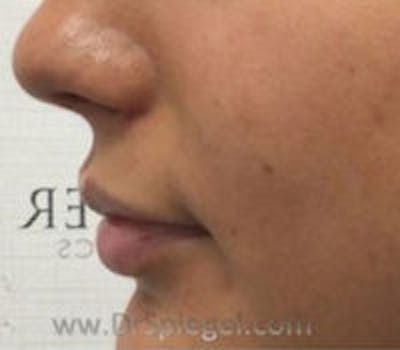 Lip Filler Before & After Gallery - Patient 157140823 - Image 3