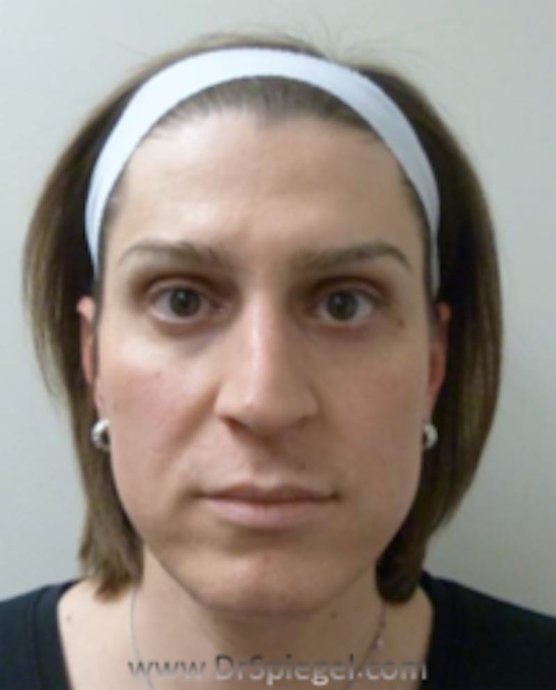 FFS Before & After Gallery - Patient 157140826 - Image 1