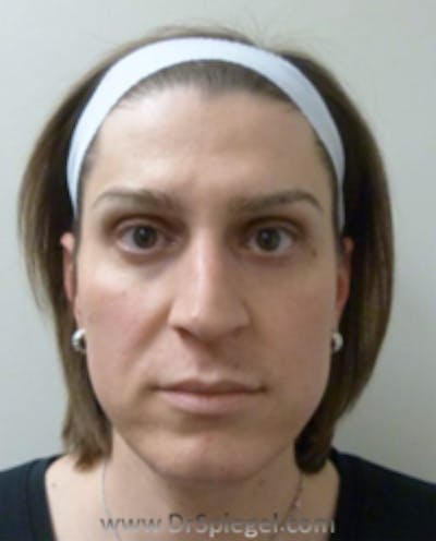 FFS Before & After Gallery - Patient 157140826 - Image 1