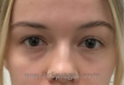Tear Trough / Under Eye Fillers Before & After Gallery - Patient 157140828 - Image 1