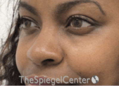 Non-Surgical Rhinoplasty / Nose Filler Before & After Gallery - Patient 157140827 - Image 3