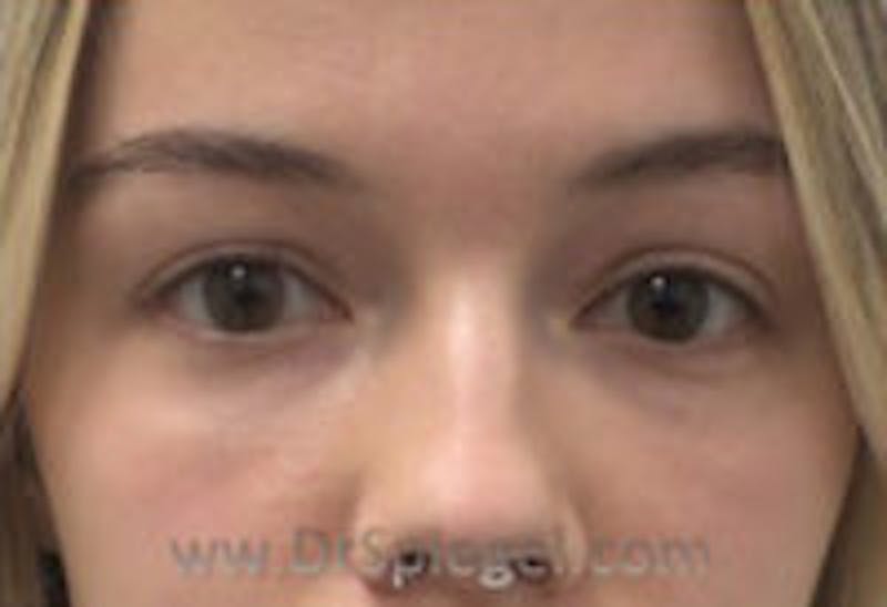 Tear Trough / Under Eye Fillers Before & After Gallery - Patient 157140828 - Image 2