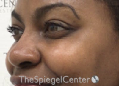 Non-Surgical Rhinoplasty / Nose Filler Before & After Gallery - Patient 157140827 - Image 4